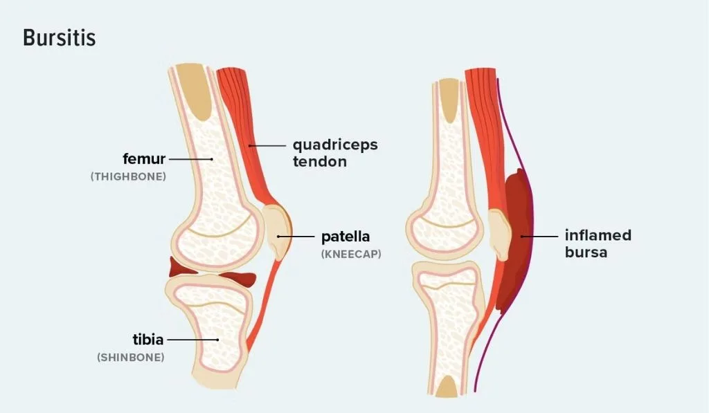 Bursiter Explained: Causes, Symptoms, Treatment and Prevention Guide